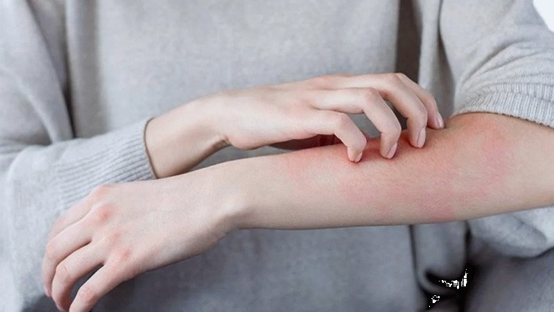 Uyuz Nedir ve Neden Artış Gösteriyor?